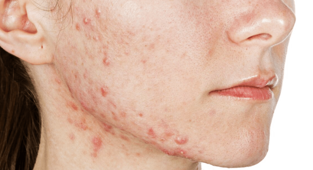 La vérité sur l’acné hormonal